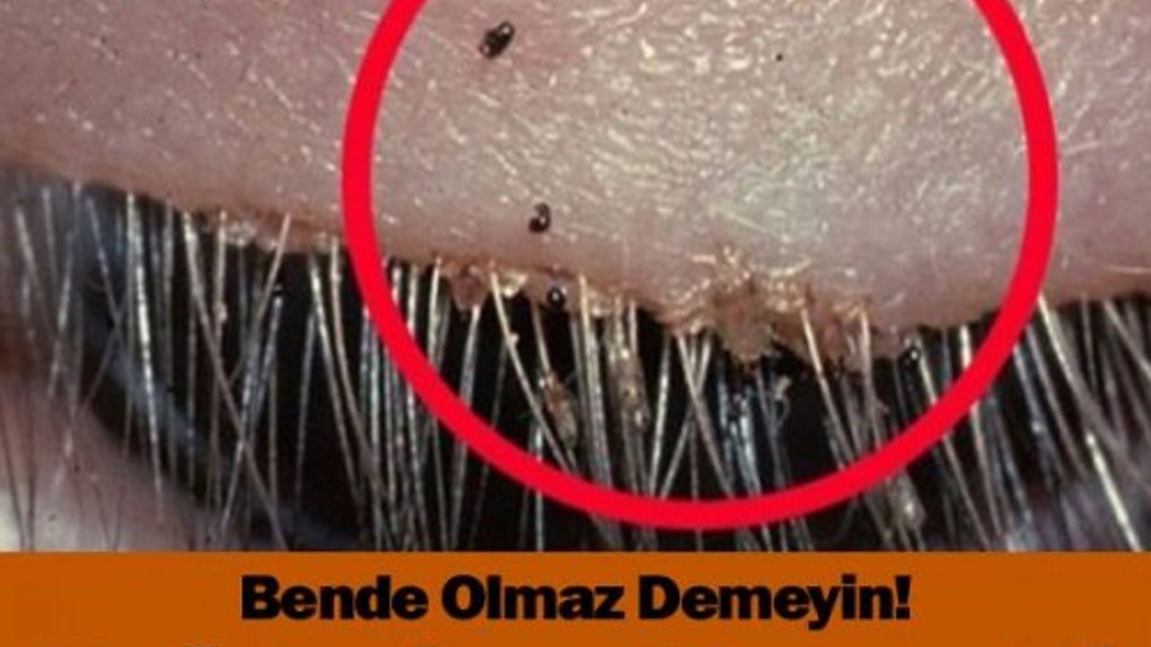 BENDE OLMAZ DEMEYİN ! ENFEKSİYON ZANNETTİ BAKIN NE ÇIKTI !
