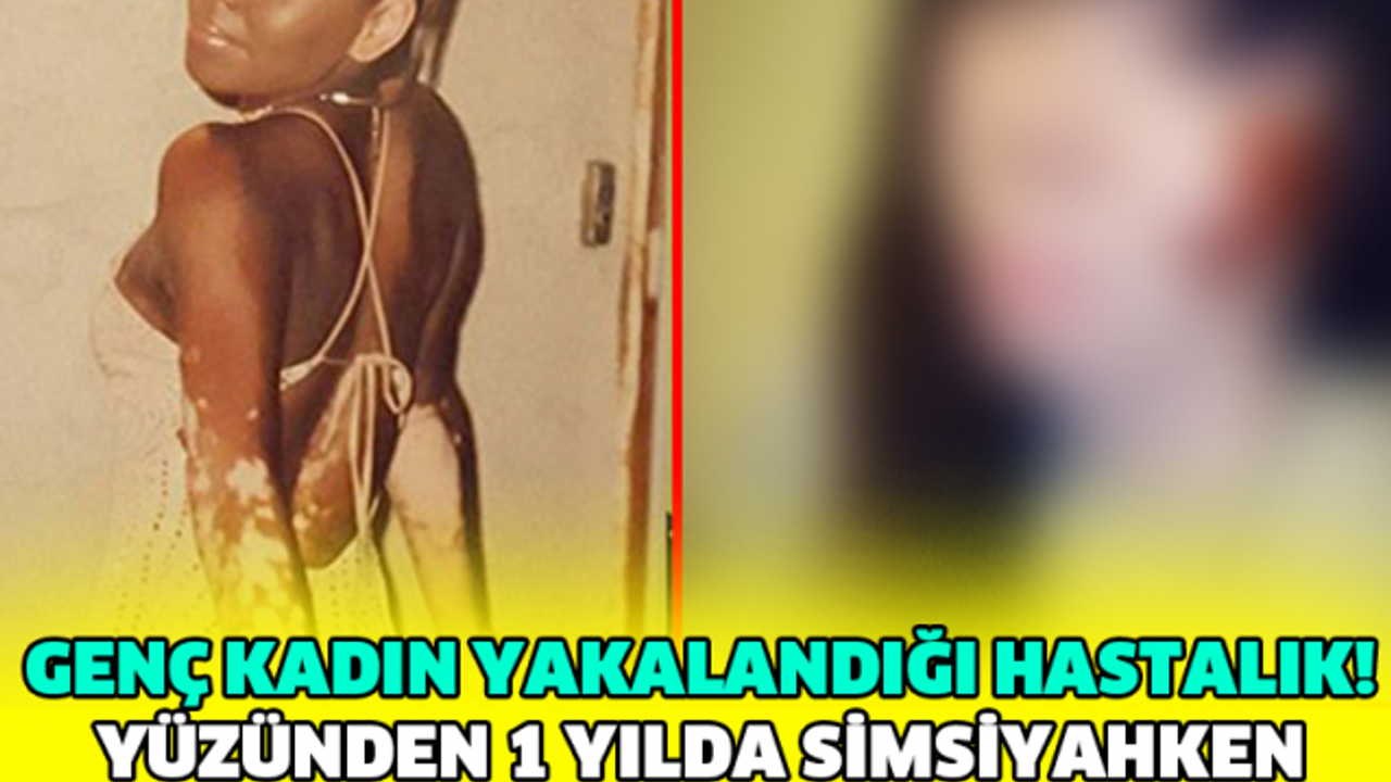 GENÇ KADIN YAKALANDIĞI HASTALIK YÜZÜNDEN 1 YILDA SİMSİYAHKEN BEMBEYAZ OLDU !