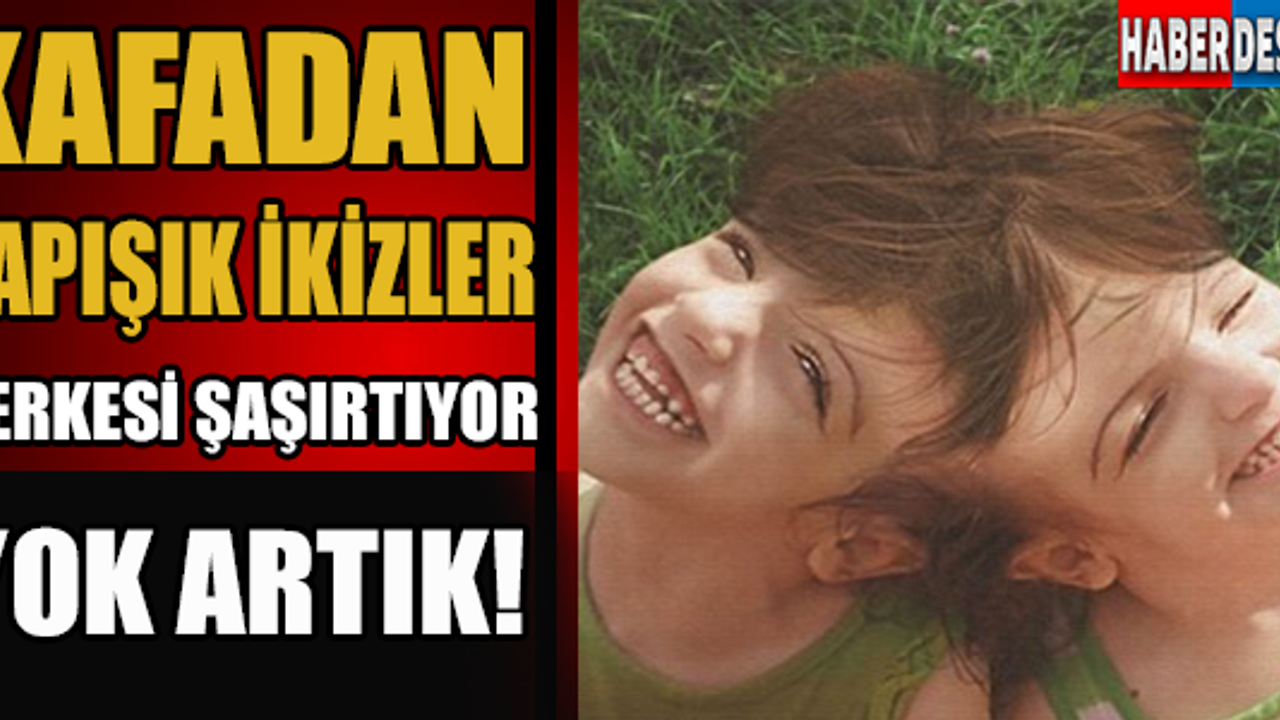 Kafadan yapışık ikizler herkesi şaşırtıyor !