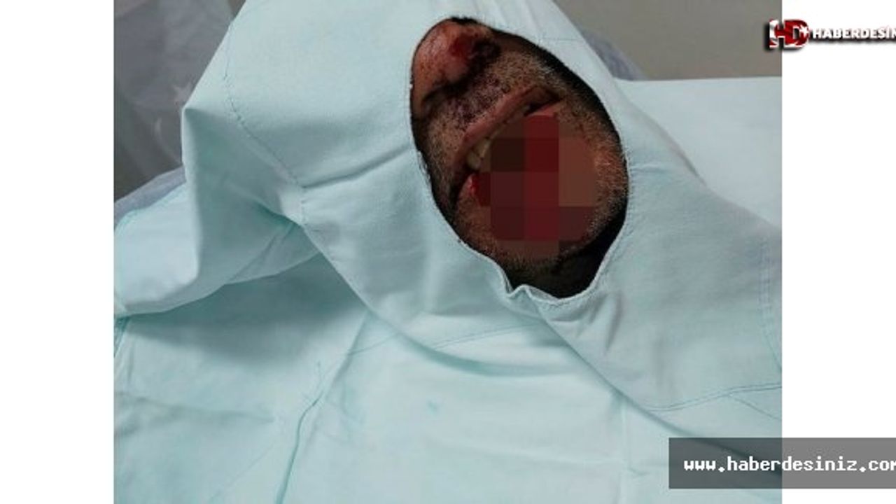 'Hannibal damat' tutuklandı! Isırarak kayınpederinin dudağını parçalamıştı.