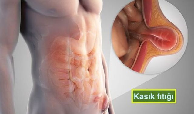 Öksürürken Kasıkta Şişlik Mi Var? Uzmanlar Uyarıyor: Fıtık Olabilir!