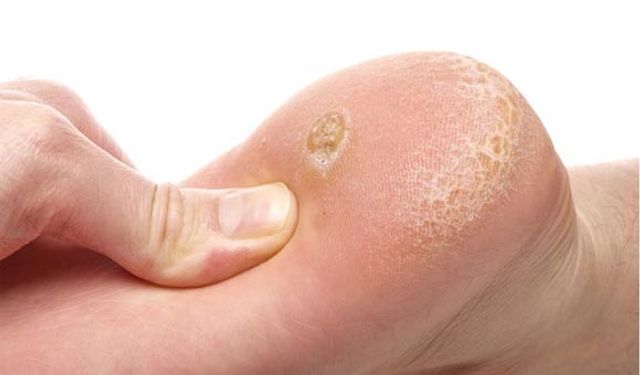 Nasır, Ayak Sağlığınızı Tehdit Ediyor! Uzmanlardan 7 Önemli Öneri