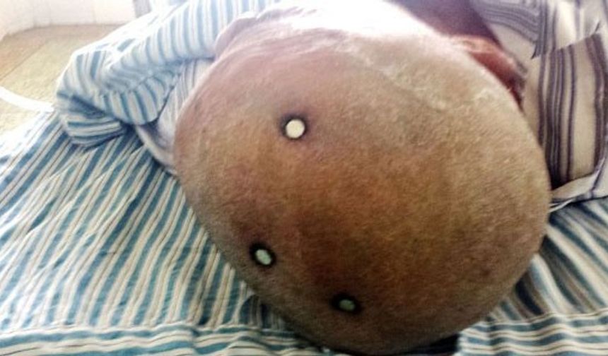 Çivilerin başları açıkça dışarıdan bile görünürken doktorlar Çinli adamın röntgenini çekti ve 3 koca çivi ile karşılaştı...