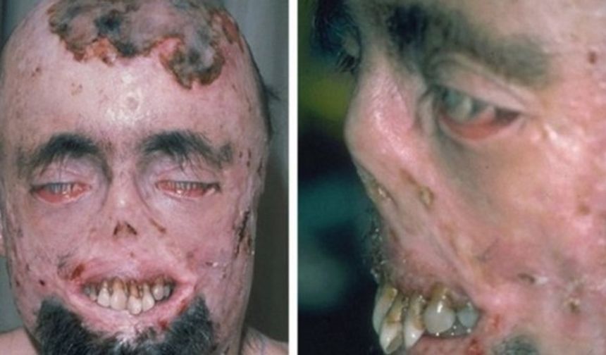 Vampir Hastalığı: Tıpta &quot;porfiriya&quot; adı verilen hastalık, enzimlerin doğuştan ya da kazanılmış bozukluğu ya da eksikliği sonucunda gelişen bir hastalıktır. Vampir efsanelerinin bu hastalık nedeniyle ortaya çıktığı söylenmektedir.