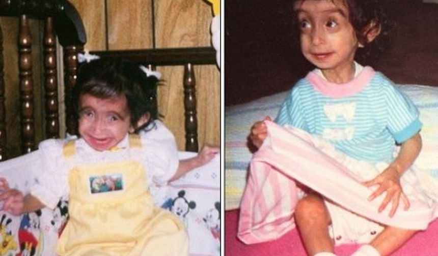 Doğduğundan beri kilo alma problemi yaşayan ve tabiri caizse ‘bir deri, bir kemik‘ görünen 26 yaşındaki Amerikalı Velasquez, hayatı boyunca 29 kilonun üzerine hiç çıkamadı. Bir gözü de görmeyen ve bütün çocukluğunu bu rahatsızlıklarına çare arayarak geçiren genç kadın, ergenliğinde ise okuldaki arkadaşlarının kinayeli lafları ve aşağılamalarına maruz kaldı.