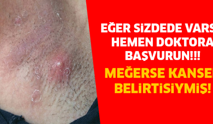 Eğer sizdede varsa hemen doktora başvurun! Meğerse kanser belirtisiymiş...