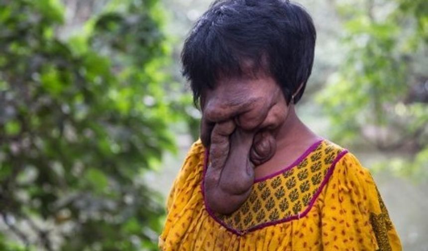 Hindistan&#039;da yaşayan genç kızın yüzüne bakan donup kalıyor. Doktorların ameliyat olması durumunda ölebileceğini söylemesi üzerine genç kız acı gerçeği kabullendi. Hindistan&#039;da yaşayan 21 yaşındaki Khadija Khatoon (Hatice Hatun), doktorların ameliyat olması durumunda ölebileceğini söylemesi üzerine alnından sarkan büyük miktarda deri yüzünü kaplamış şekilde hayatını sürdürüyor.