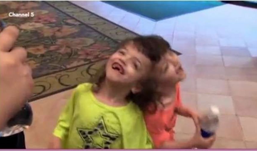 Kanada&#039;lı Tatiana ve Krista Hogan diğer ikiz kardeşlerden farklı olarak kafa tasları birbirine yapışık olarak dünyaya geldiler.